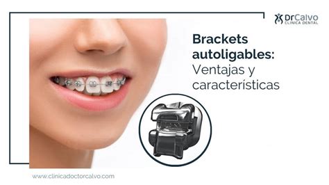 que es un bracket autoligable